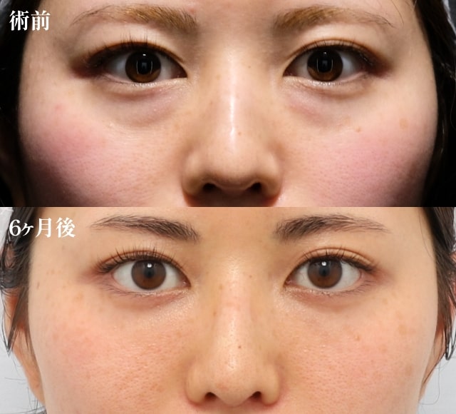 裏ミッドフェイスリフト-Pono式PRP皮膚再生療法（目の下）