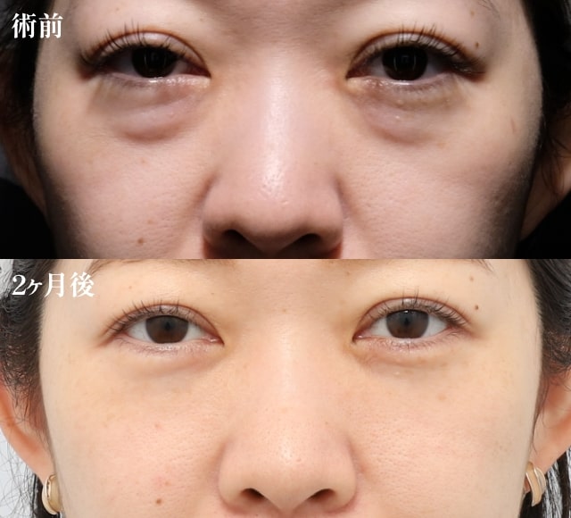 PRPF療法（目の下、ゴルゴライン）