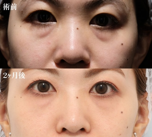 PRPF療法（目の下、ゴルゴライン）