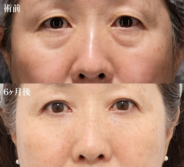 裏ミッドフェイスリフト-二重埋没法2ループ