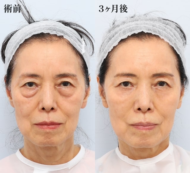 裏ミッドフェイスリフトPRPF療法（目の下、法令線）