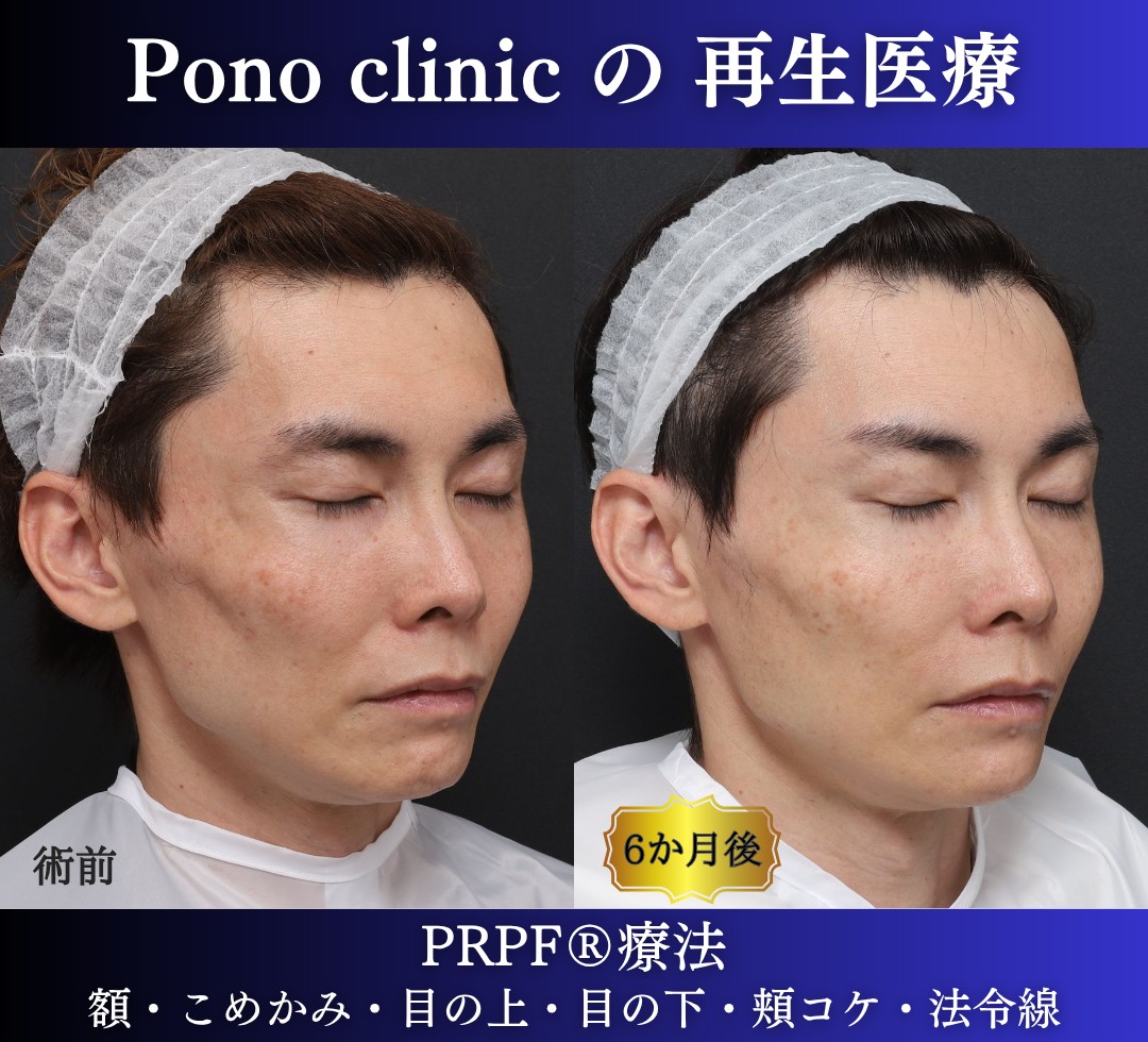 40代男性の症例、アンチエイジング治療、PRPF療法 (1)