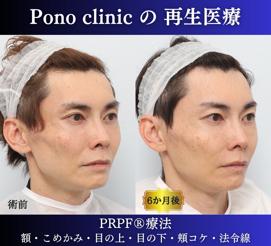 40代男性の症例、アンチエイジング治療、PRPF療法 (2)