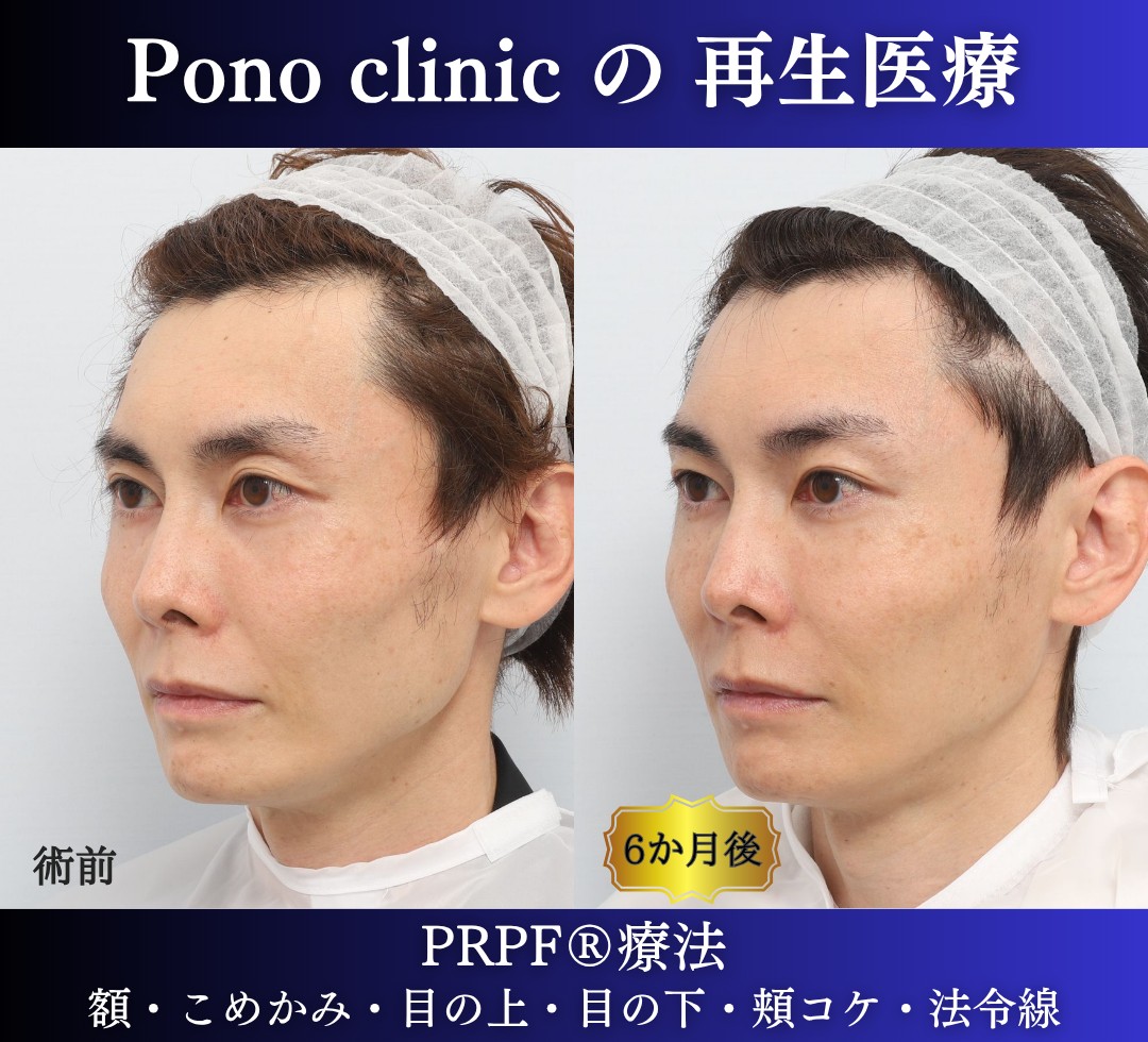 40代男性の症例、アンチエイジング治療、PRPF療法 (3)