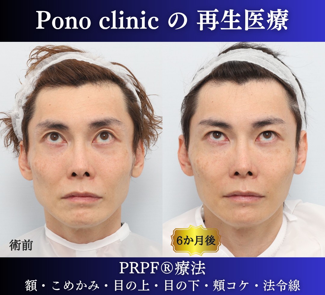 40代男性の症例、アンチエイジング治療、PRPF療法 (4)