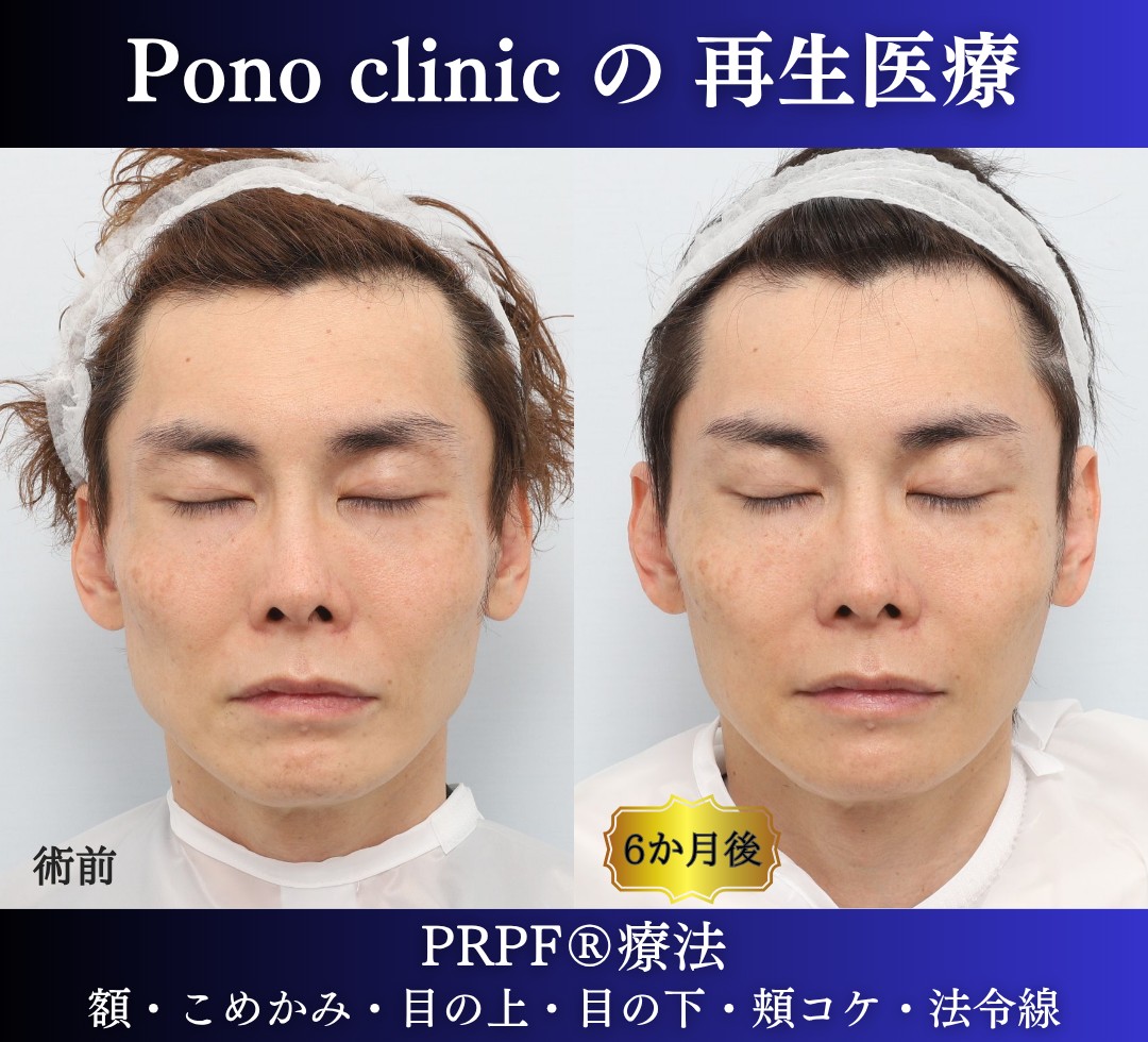 40代男性の症例、アンチエイジング治療、PRPF療法 (5)