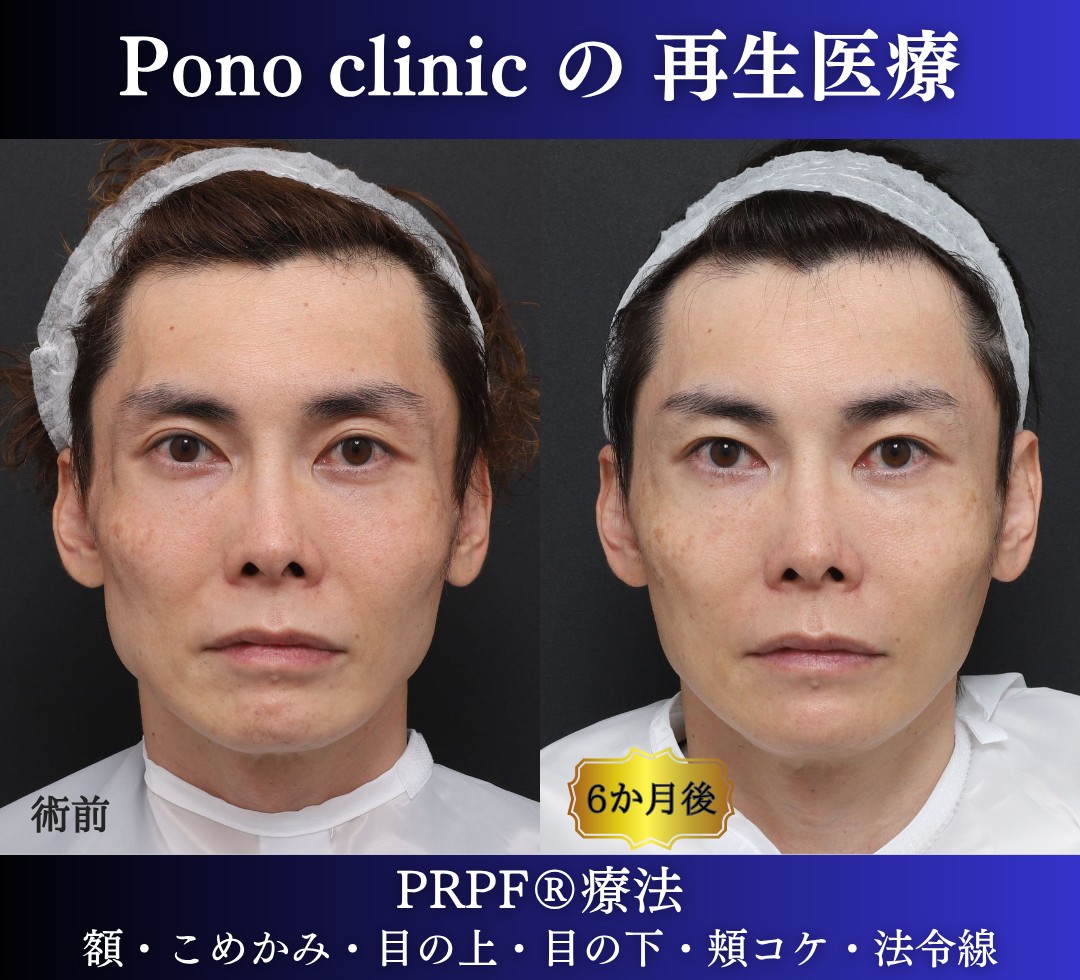 40代男性の症例、アンチエイジング治療、PRPF療法 (6)