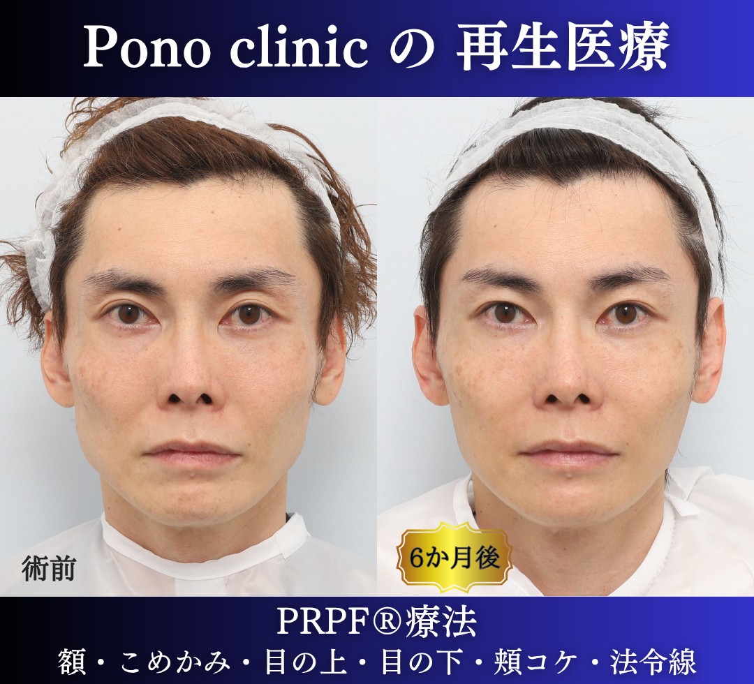 40代男性の症例、アンチエイジング治療、PRPF療法 (7)