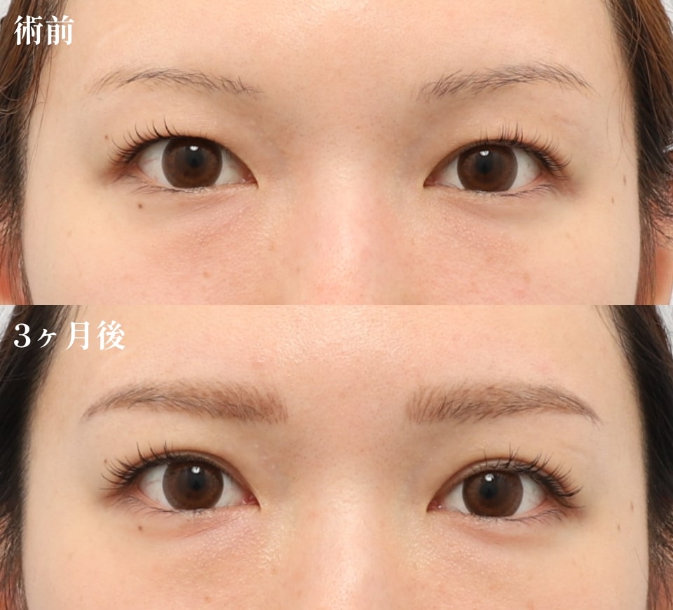 二重埋没2ループ