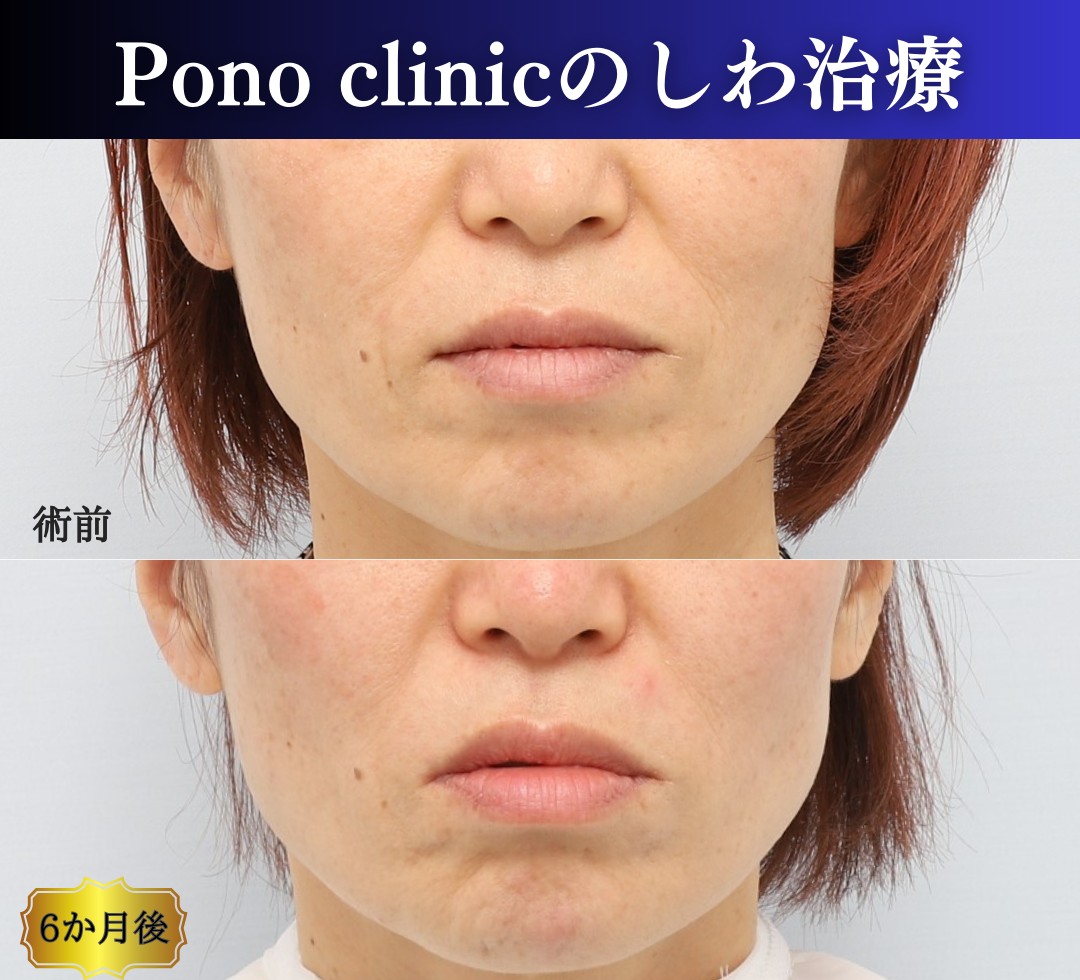 PRPF療法法令線の症例