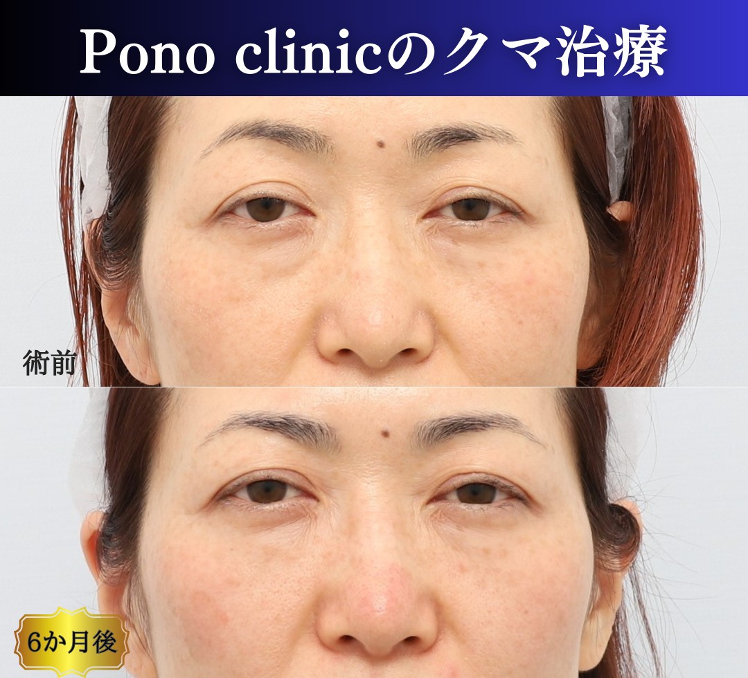 PRPF療法目の下ゴルゴラインの症例