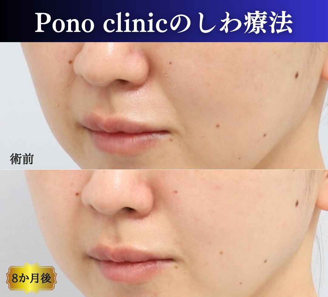 PRPF療法鼻翼基部・法令線の症例