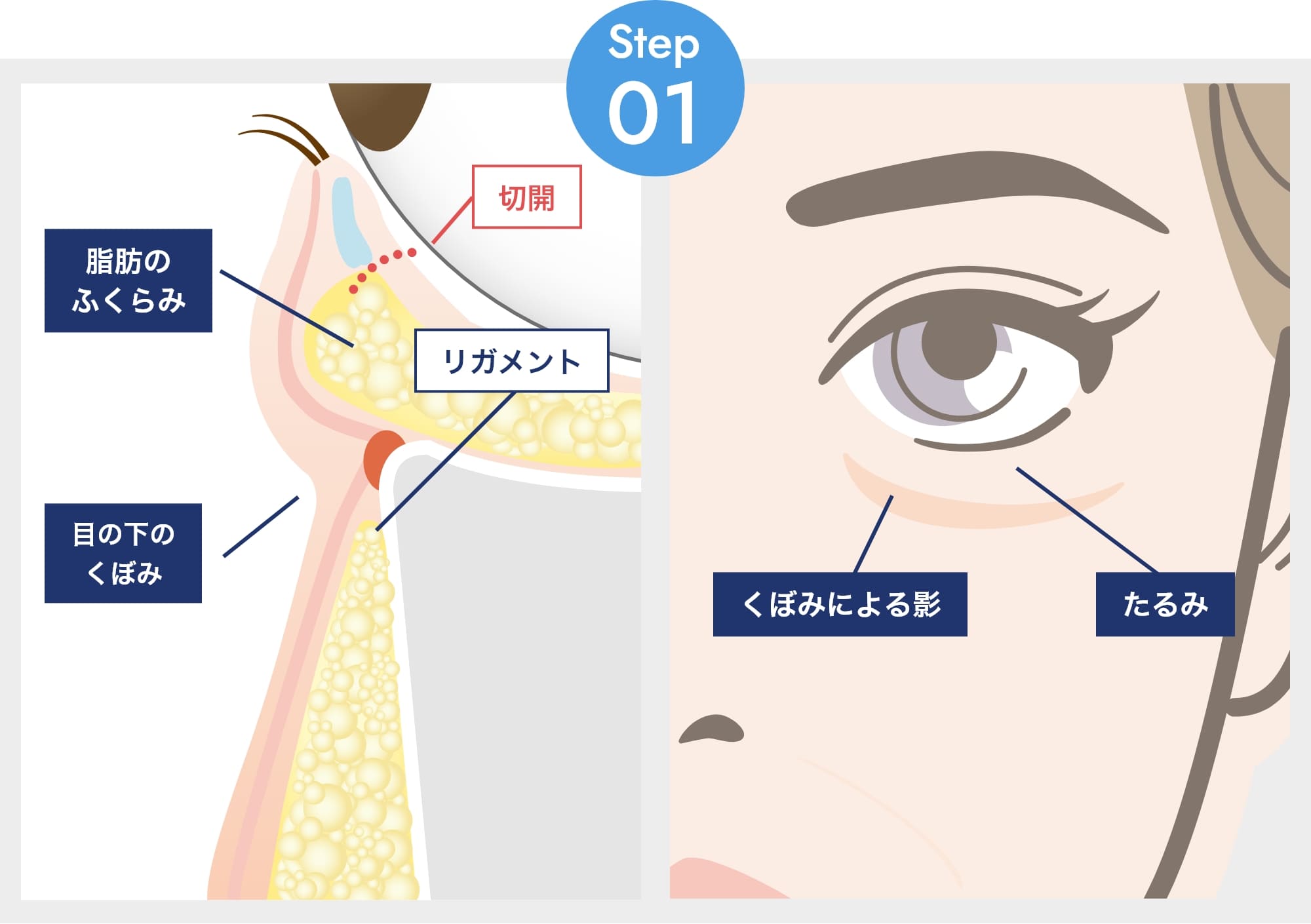 裏ミッドフェイスリフトの施術方法Step.01