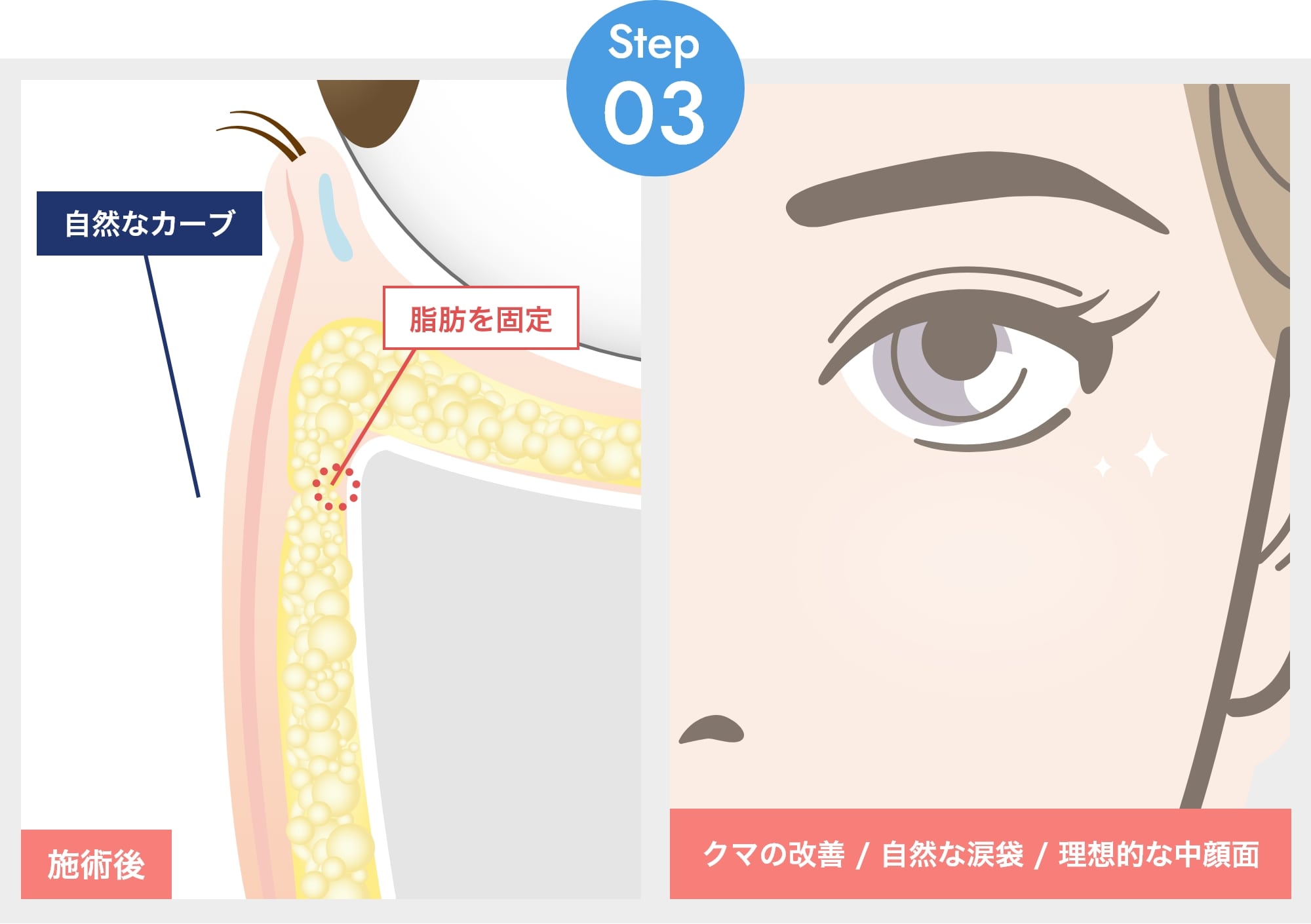 裏ミッドフェイスリフトの説明03