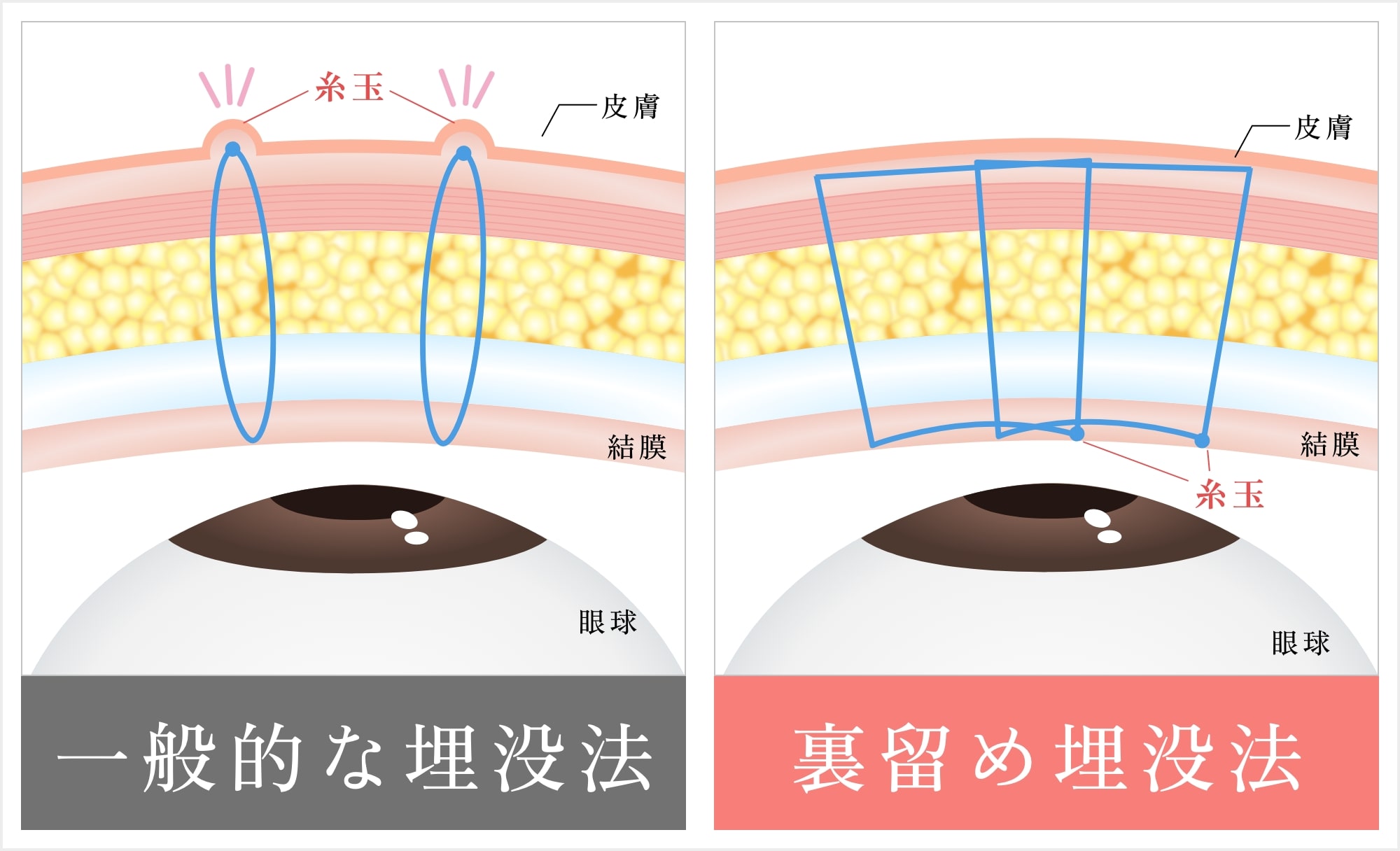 一般的な埋没法と裏留め埋没法の違い