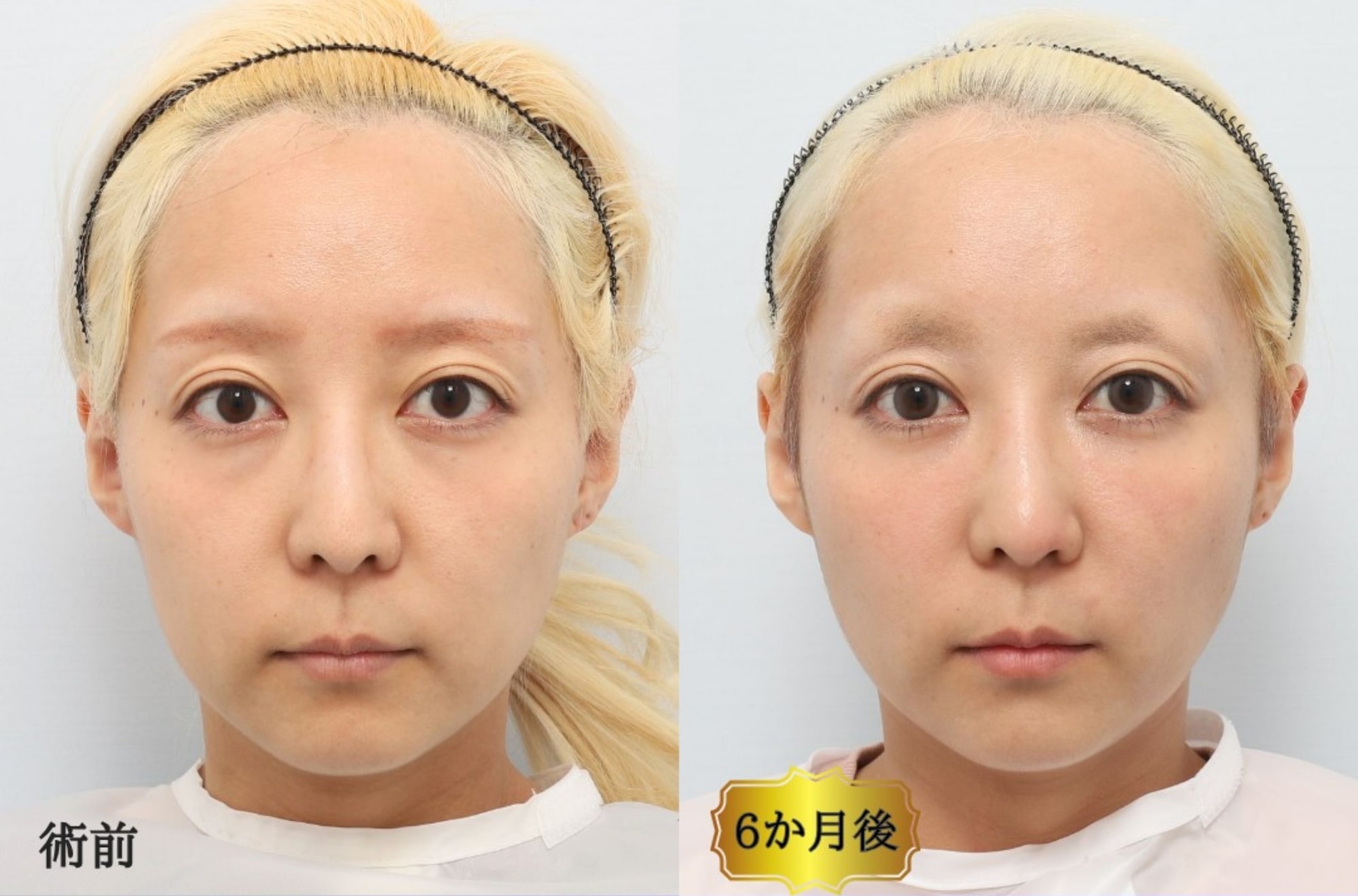 CASE1:裏ミッドフェイスリフト®