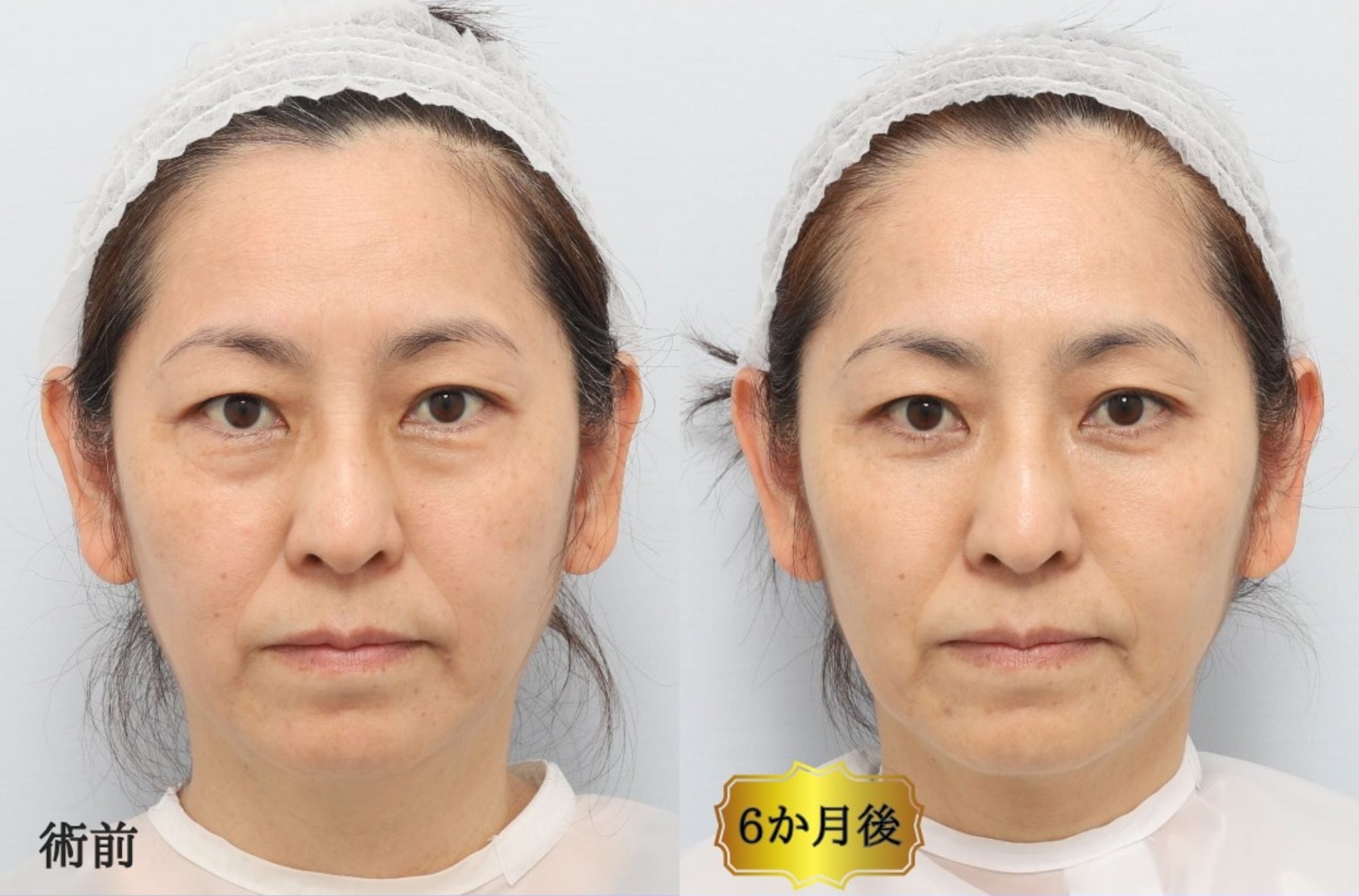 CASE2:裏ミッドフェイスリフト®