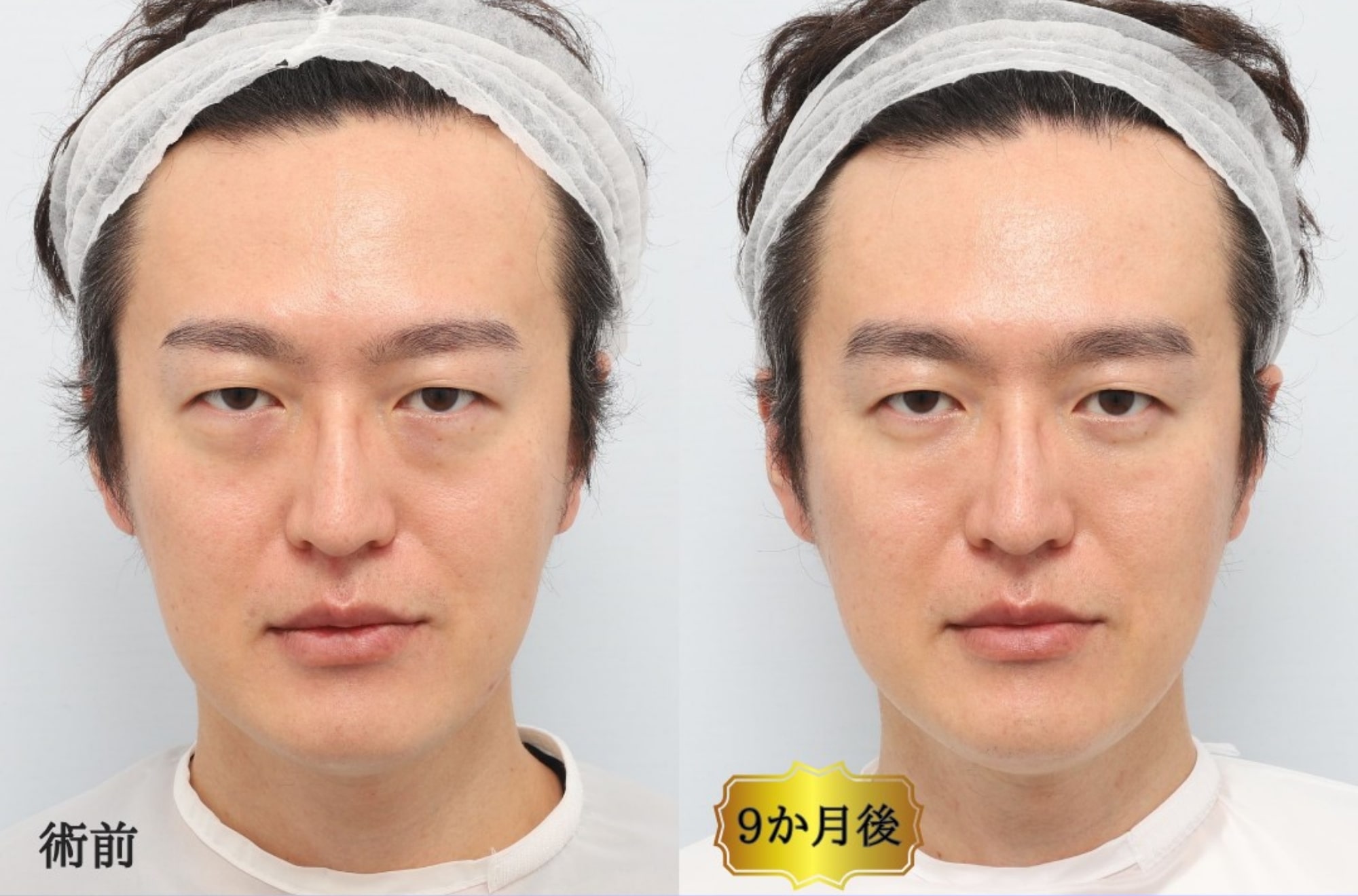 CASE3:裏ミッドフェイスリフト®