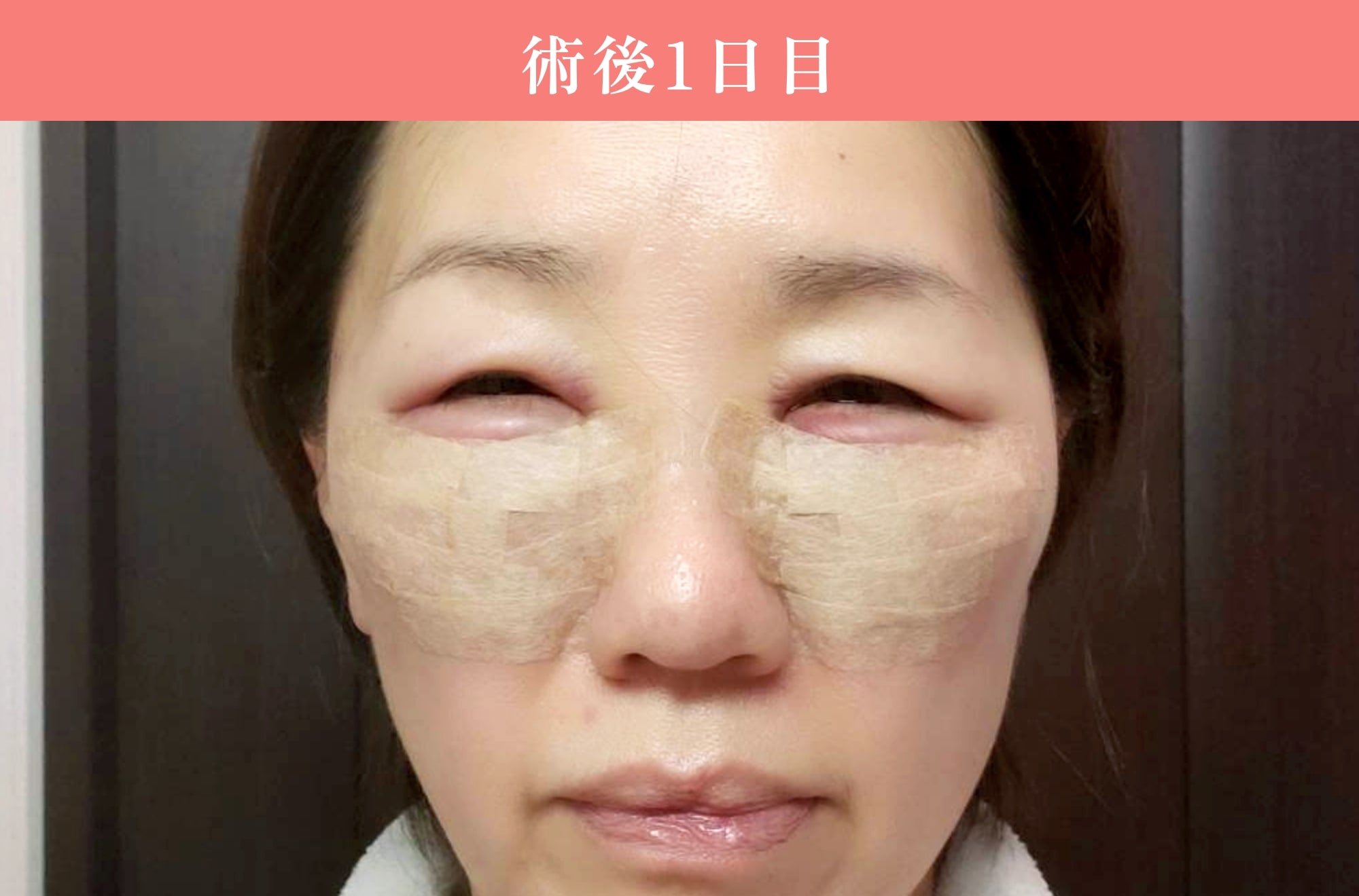 裏ミッドフェイスリフト®ダウンタイム1日目