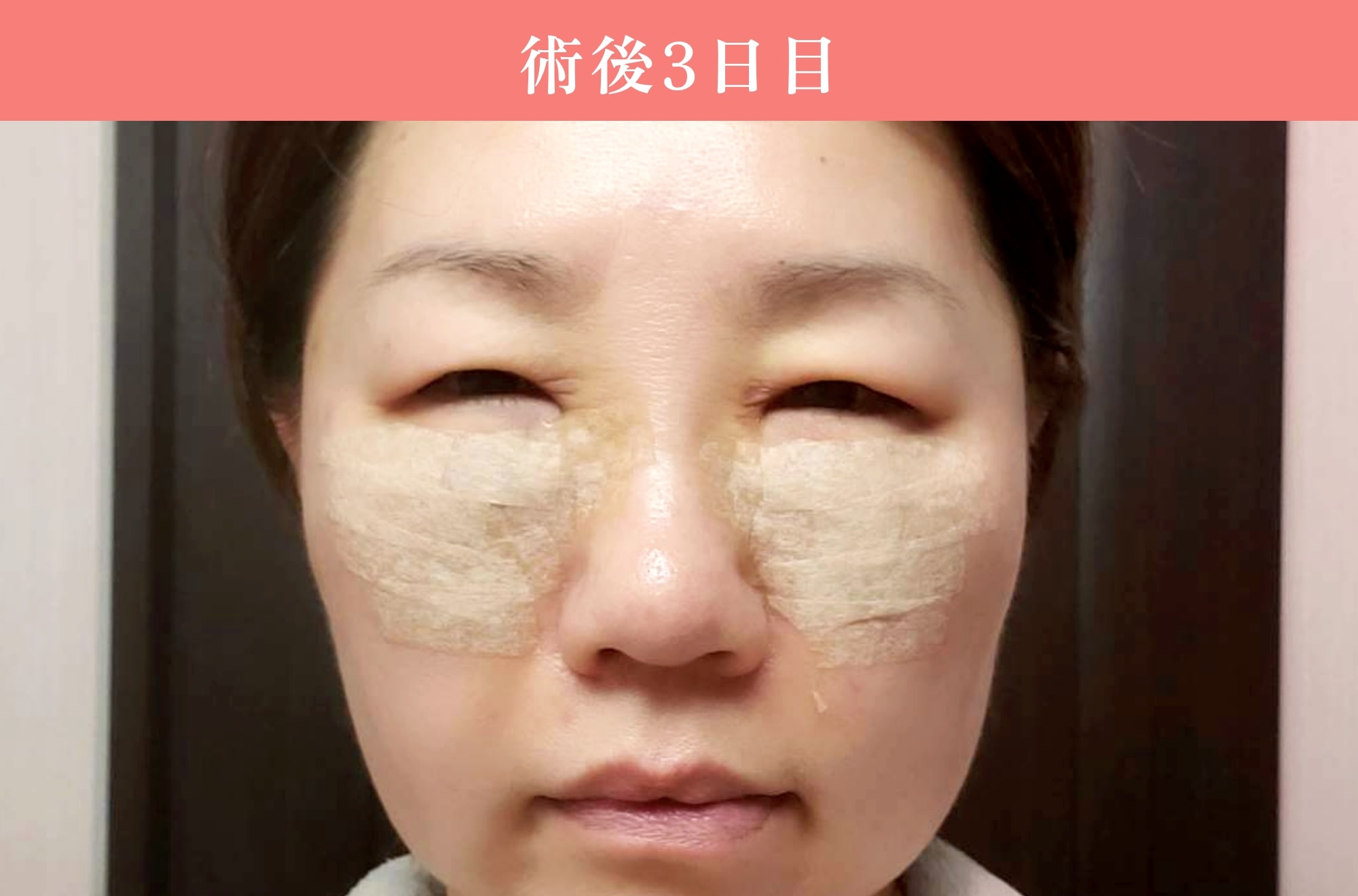 裏ミッドフェイスリフト®ダウンタイム3日目