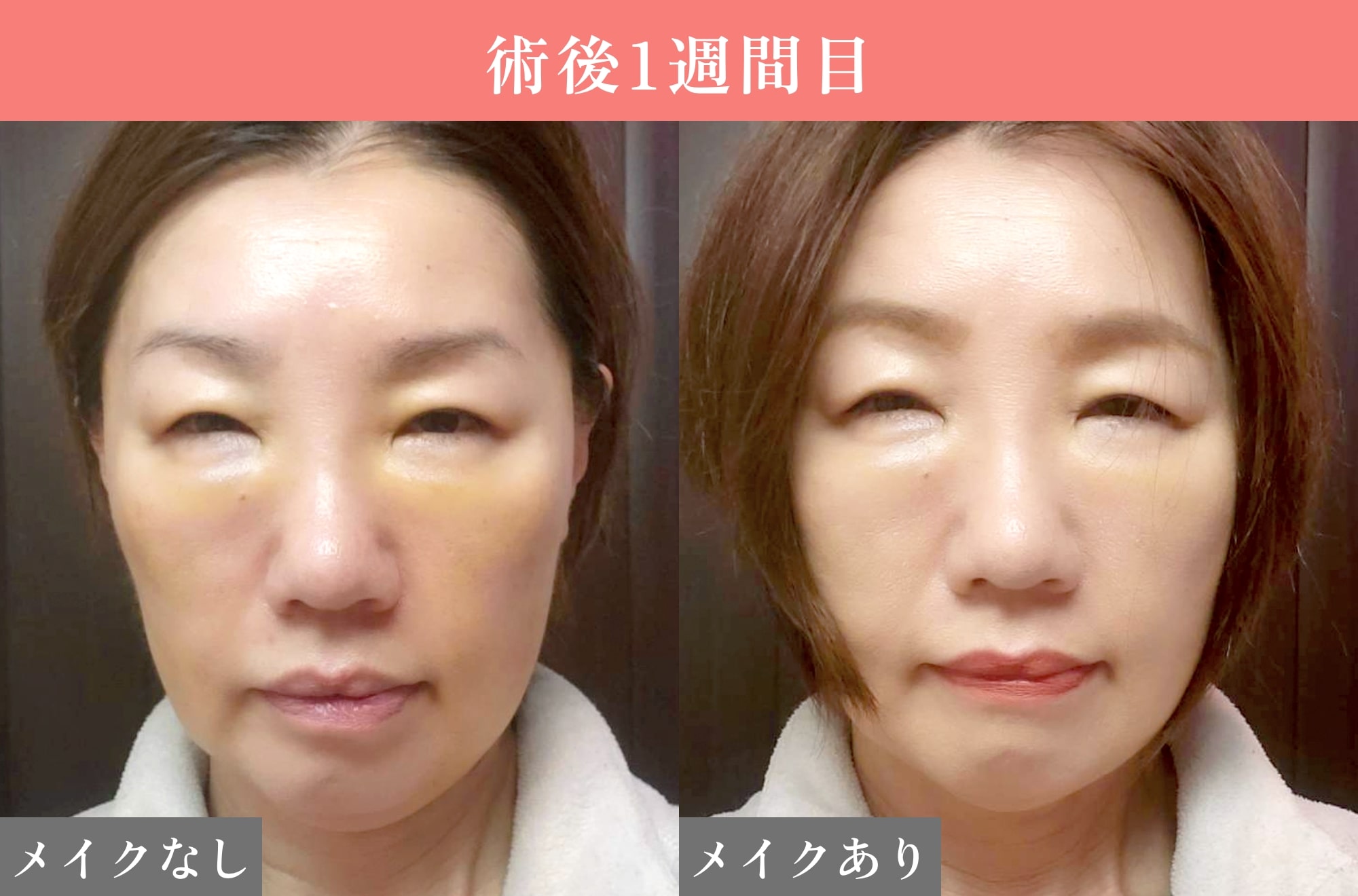 裏ミッドフェイスリフト®ダウンタイム1週間目