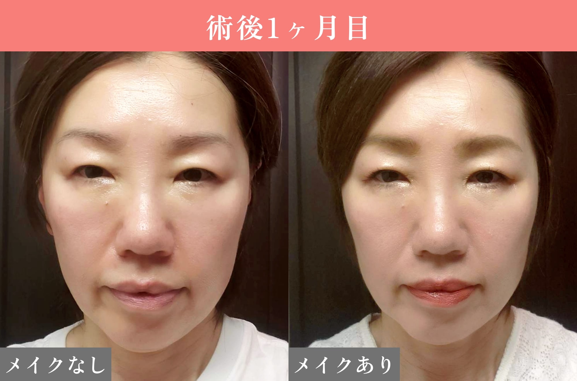 裏ミッドフェイスリフト®ダウンタイム1ヶ月目