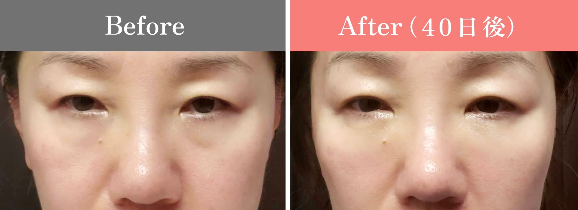 裏ミッドフェイスリフト®のビフォーアフター