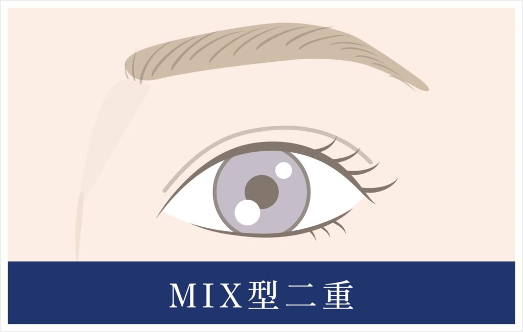 MIX型二重