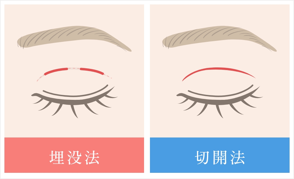 埋没法と切開法の比較