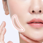 バッカルファット除去