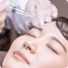 ボトックス注射