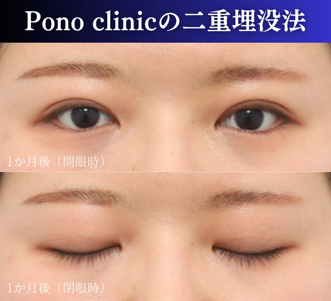 二重埋没2ループ症例、1か月後