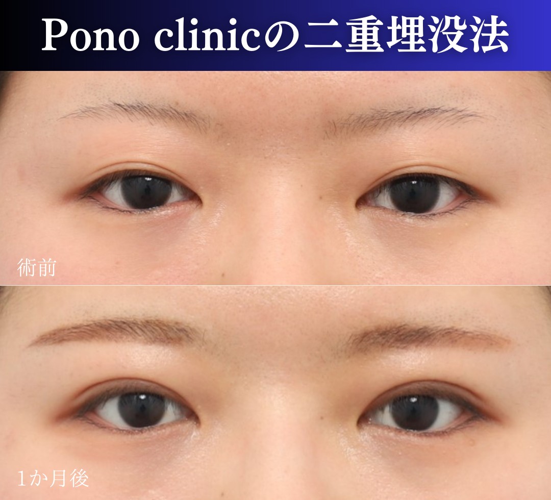 二重埋没2ループ症例、前