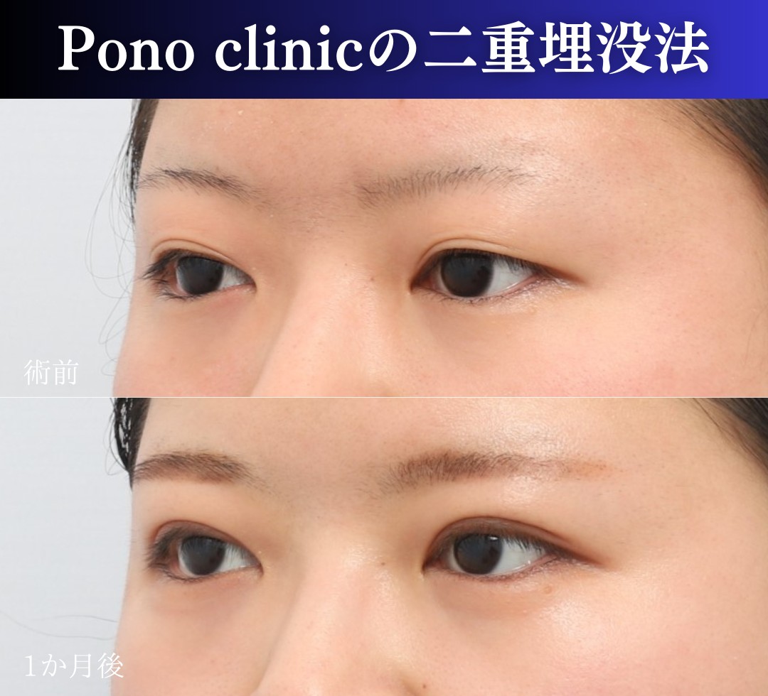 二重埋没2ループ症例、斜め