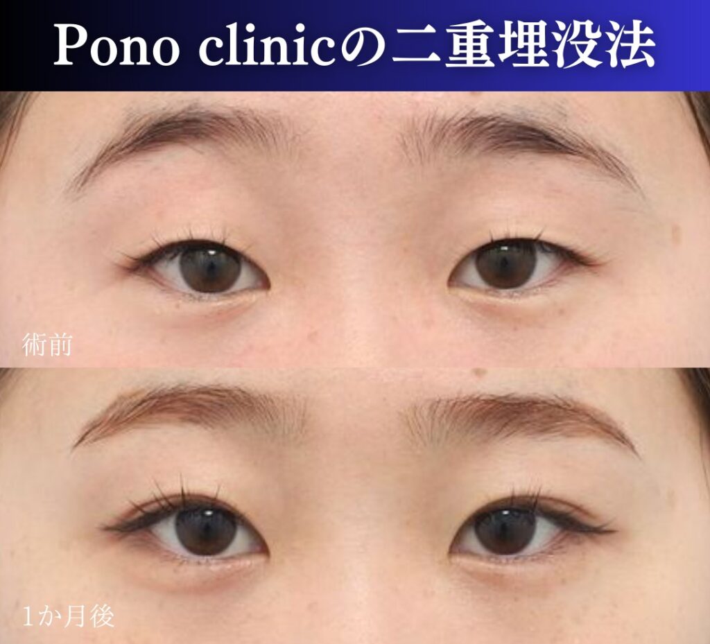 二重埋没法2ループの症例、前