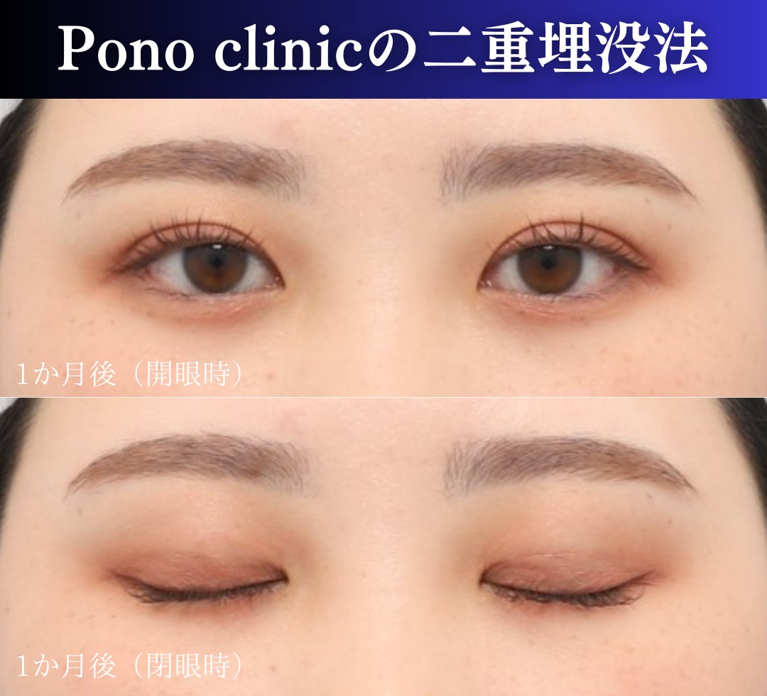 二重埋没法2ループ症例、1か月後