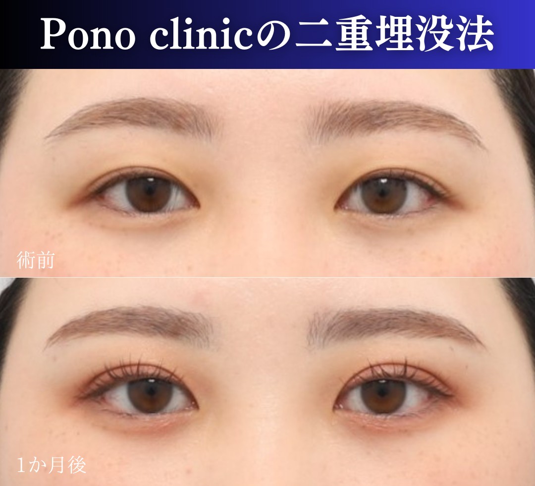 二重埋没法2ループ症例、前