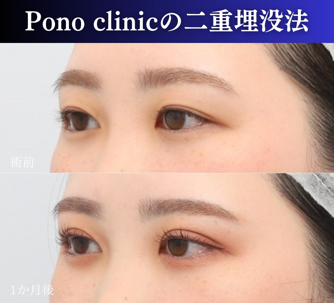 二重埋没法2ループ症例、斜め