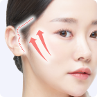 切開フェイスリフト