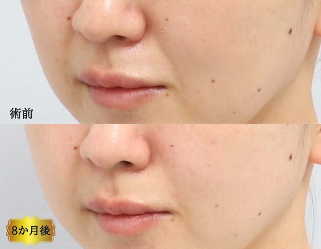 法令線のしわ改善の症例、アップ