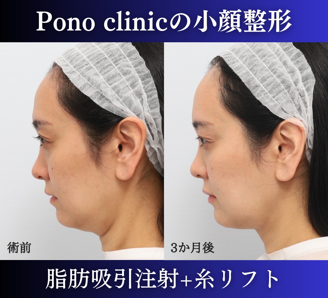 脂肪吸引注射糸リフトの症例