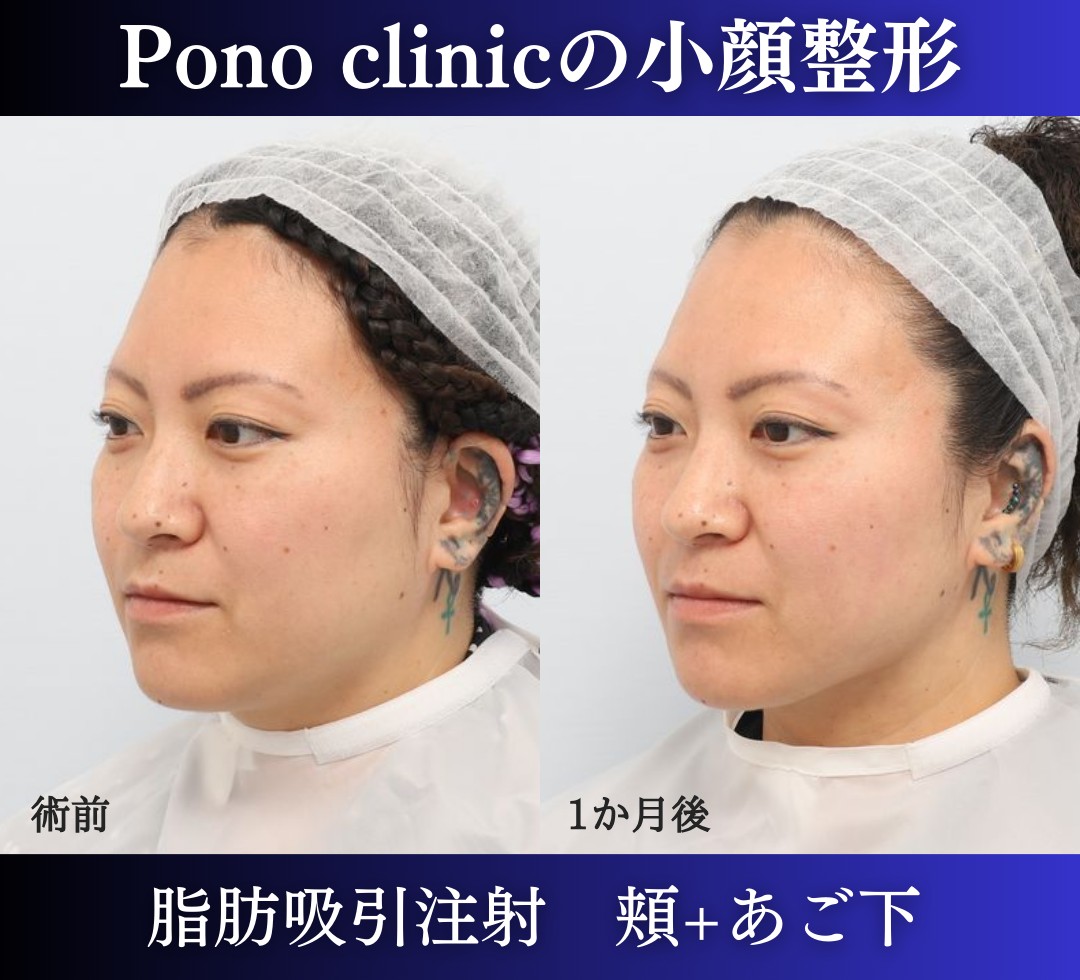 脂肪吸引注射頬+あご下の症例