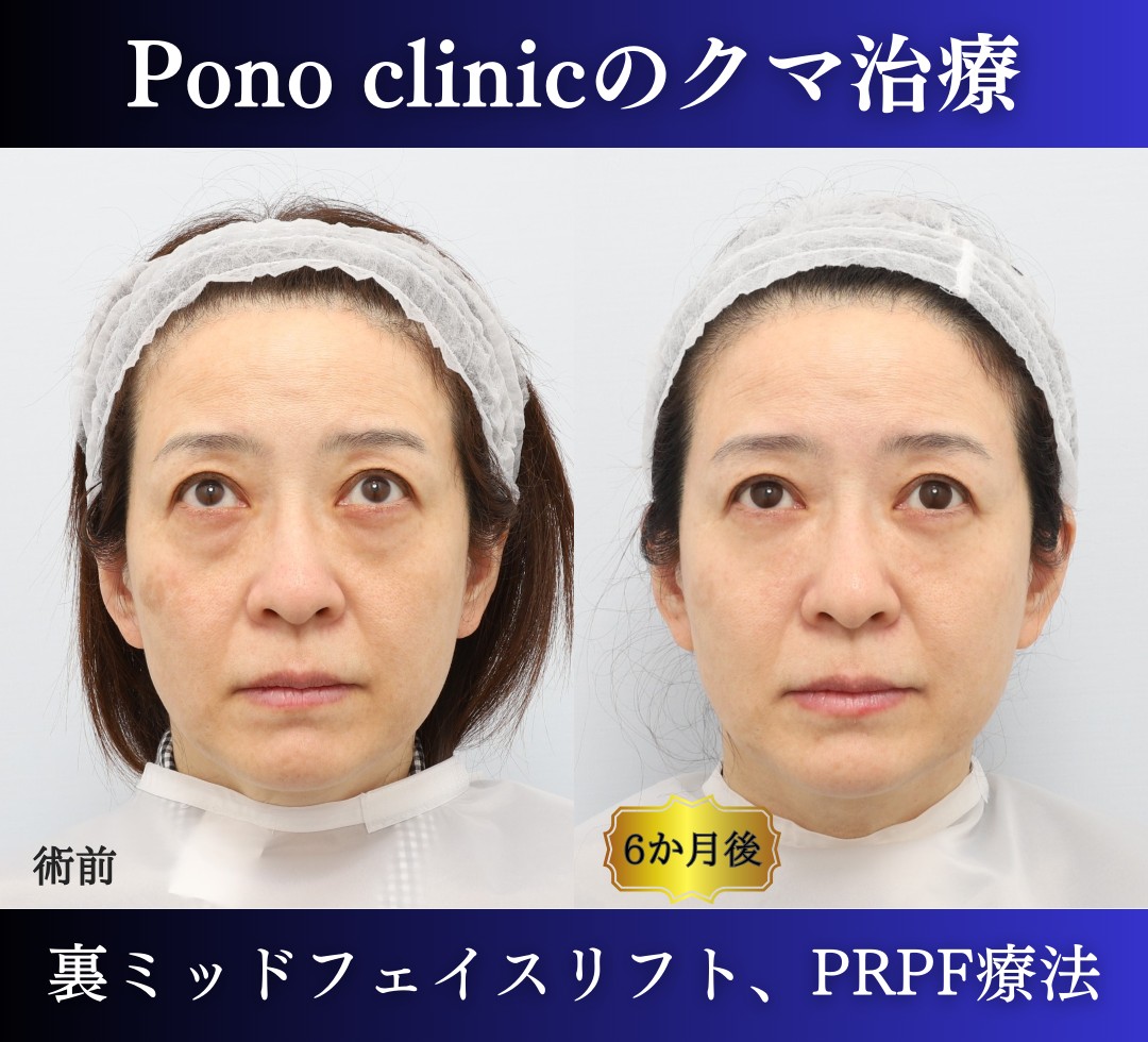 クマ取り東京、裏ハムラ・ミッドフェイスリフト、PRPF療法目の下の症例、上目線