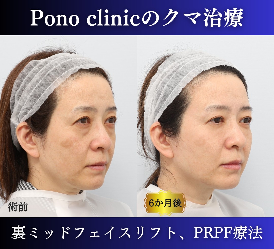 クマ取り東京、裏ハムラ・ミッドフェイスリフト、PRPF療法目の下の症例、左