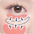 裏ハムラ・裏ミッドフェイスリフト