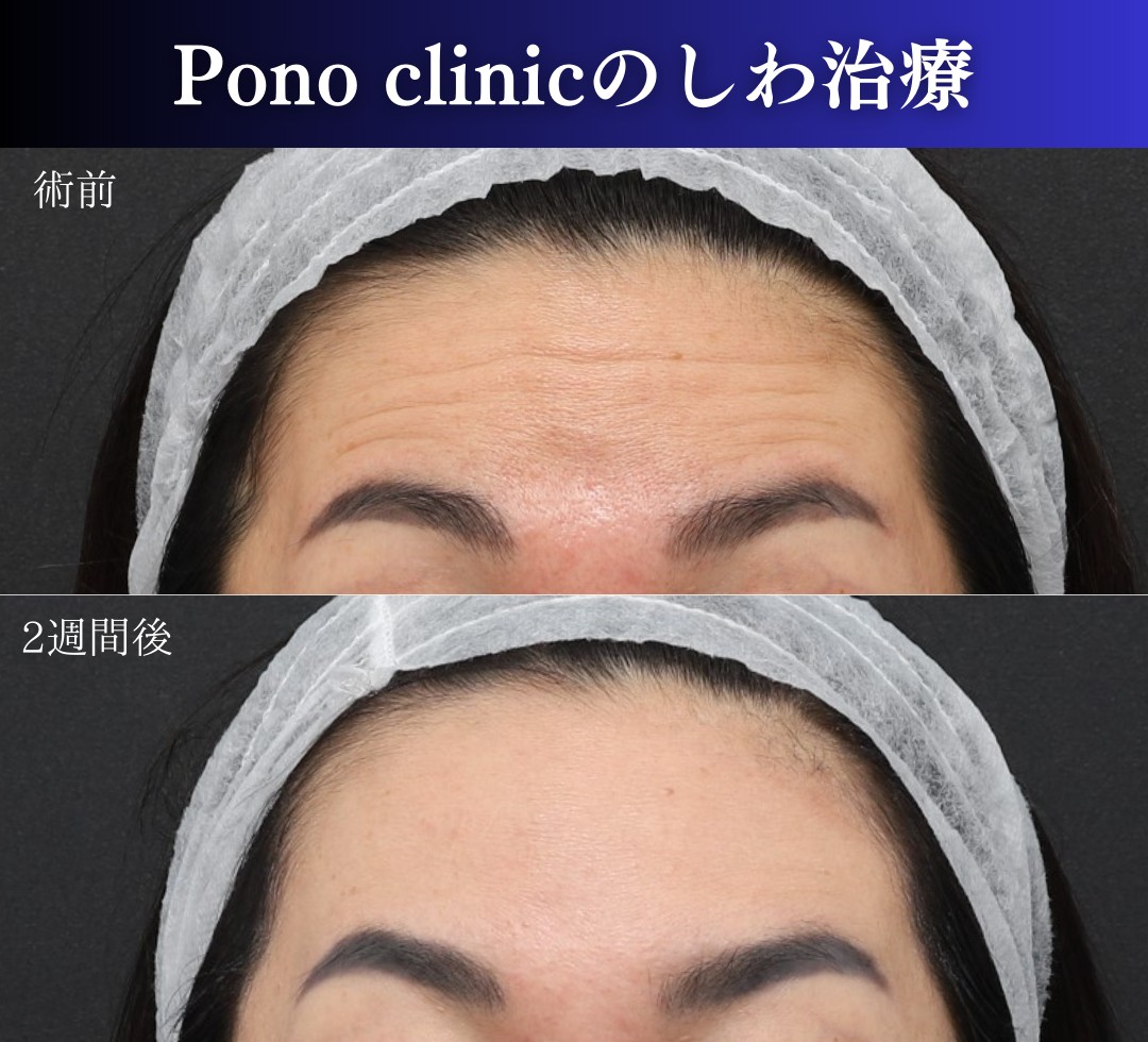 額のボトックス注射の症例