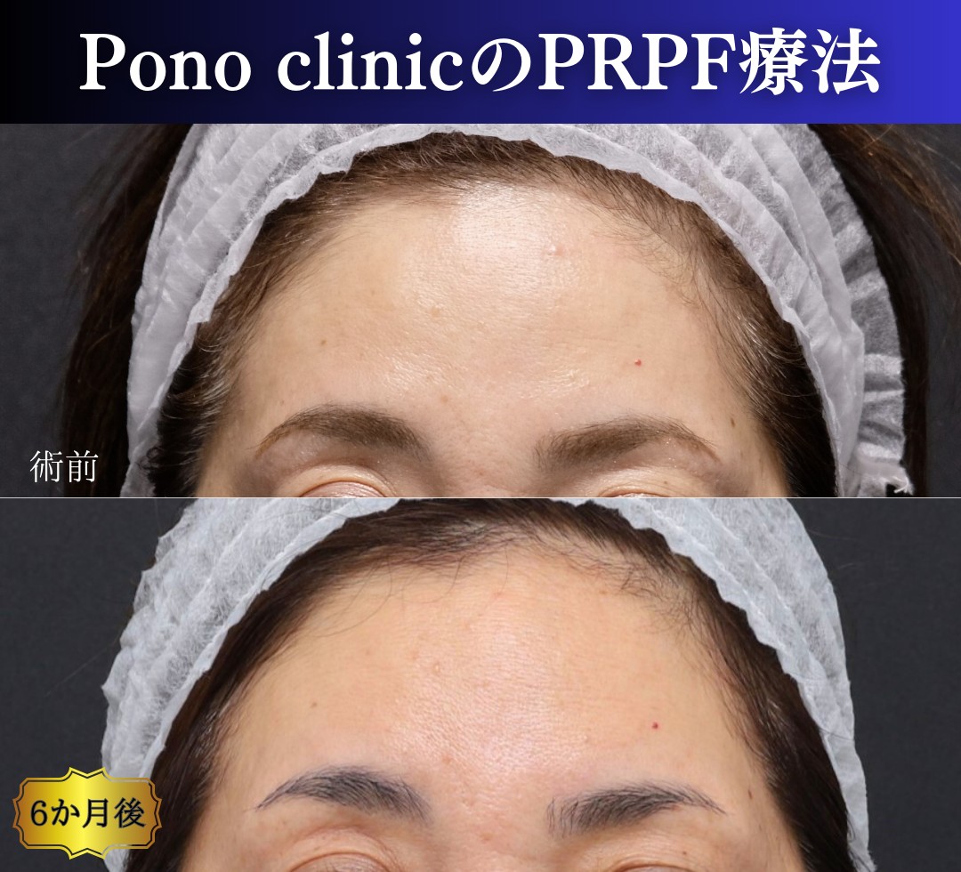 額の凹凸を整える症例、前