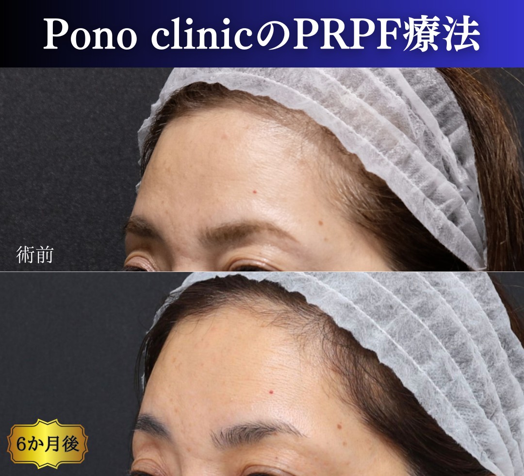 額の凹凸を整える症例、斜め