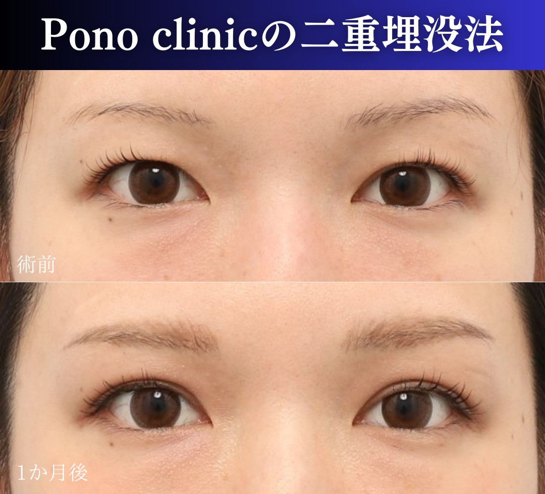 ３０代の二重埋没法の症例