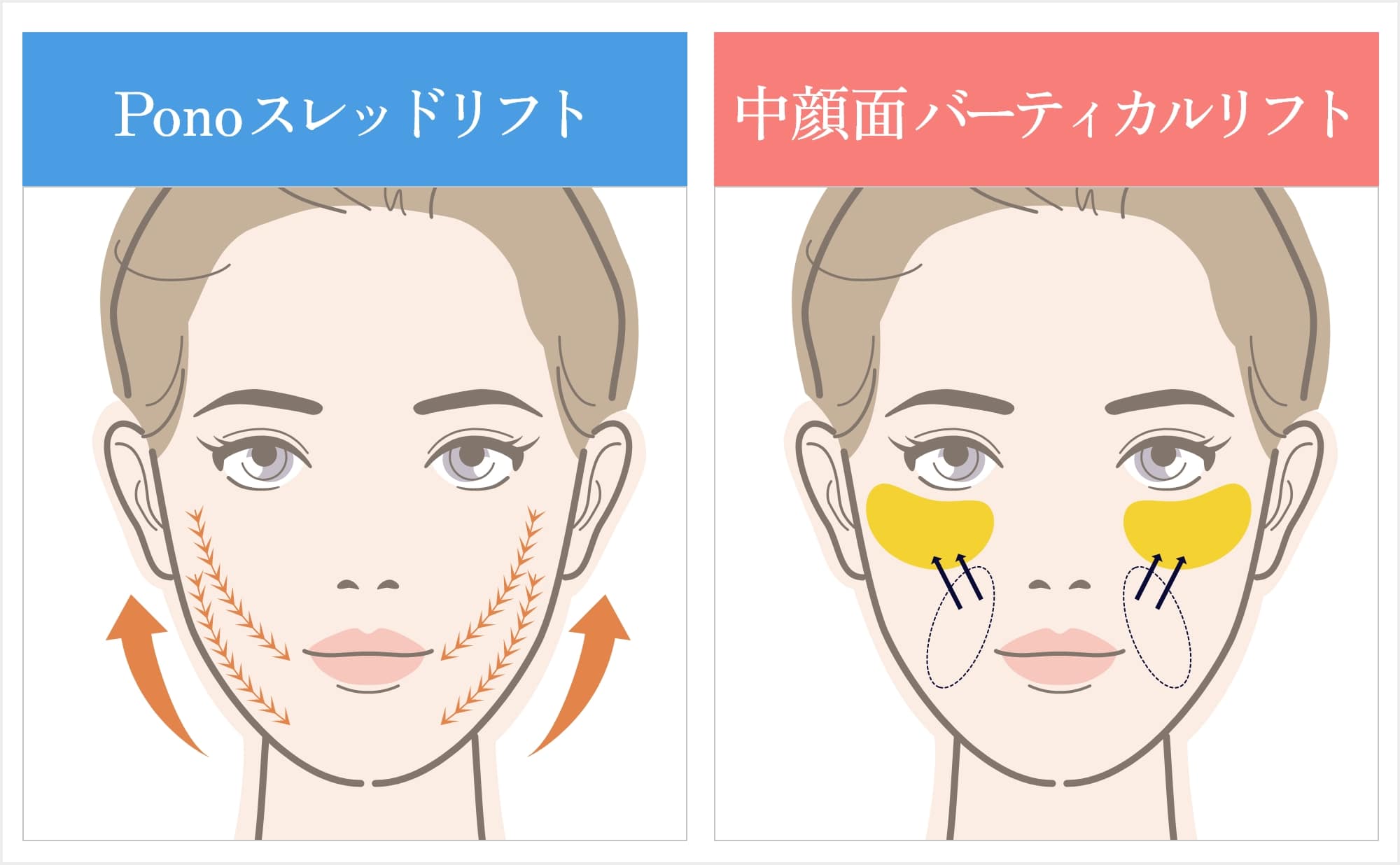 Ponoスレッドリフトと中顔面バーティカルリフトの違い